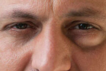 Как убрать мешки под глазами: быстрые и эффективные методы от телеграм-канала «Записки врача»